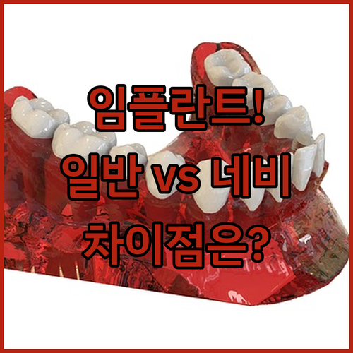 일반 임플란트와 네비게이션 임플란트 차이점 비교